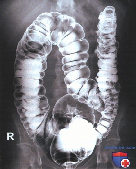 Укладка при рентгенограмме толстой кишки в ЗП или ПЗ проекции