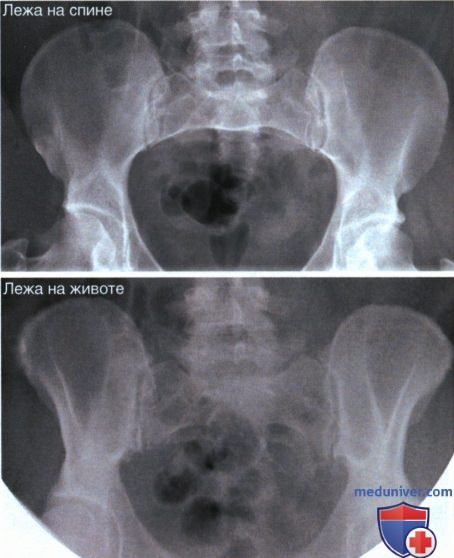 Рентгенограмма толстой кишки в ЗП или ПЗ проекции
