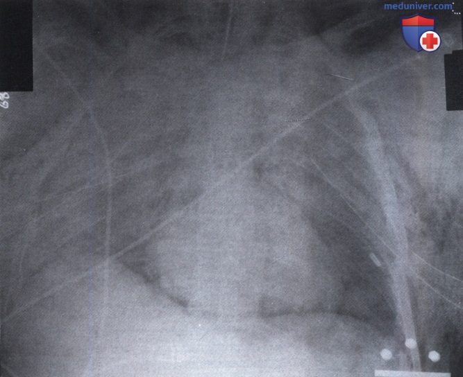 Рентгенограмма с обширным затемнением легочных полей после травмы