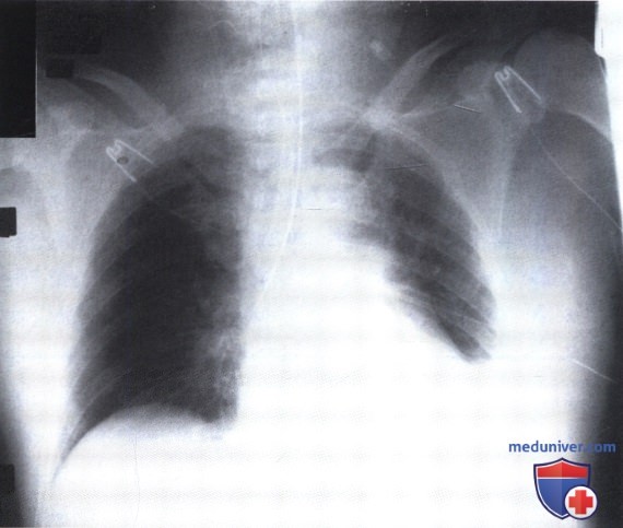 Рентгеновский снимок с затемнением левого легочного поля при миграции эндотрахеальной трубки