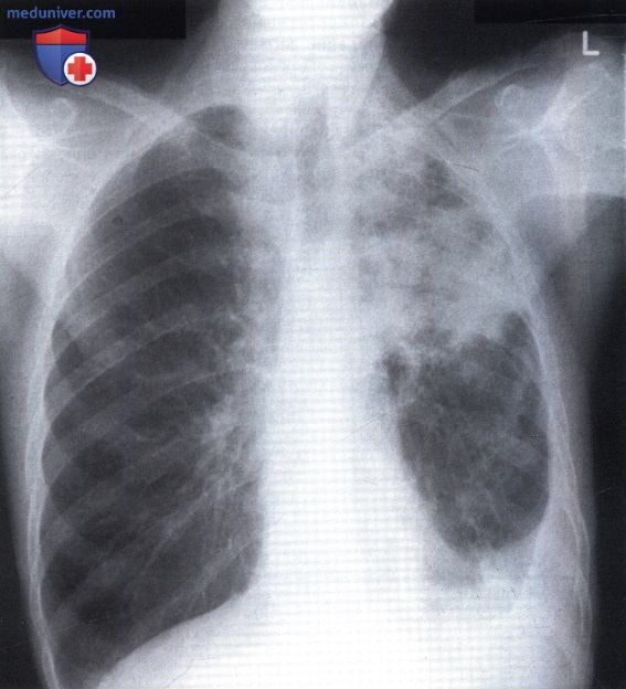 Рентгеновский снимок с участками затемнения в легком при туберкулезе