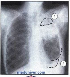 Рентгеновский снимок с участками затемнения в легком при туберкулезе