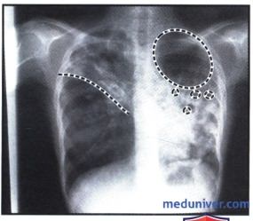 Рентгенограмма с областями затемнения в обоих легких при туберкулезе