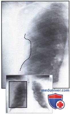 Рентгеновский снимок с участками затемнения в обоих легких при мезотелиоме