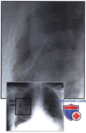 Рентгенограмма с зонами затемнения и просветления в правой половине грудной клетки при ущемлении легкого