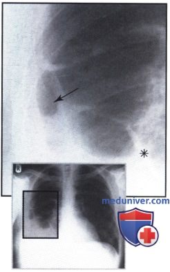 Рентгенограмма с областью затемнения в правом легочном поле при выпоте
