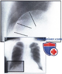 Рентгеновский снимок с необычной картиной поддиафрагмальных органов при синдроме Хилаидити