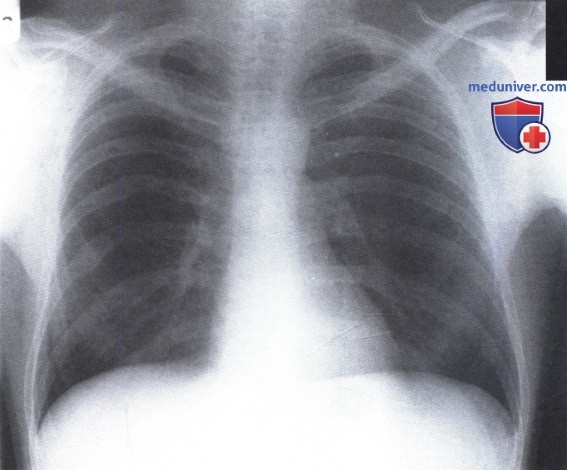 Рентгенограмма с патологическими изменениями ребер справа при застарелых переломах