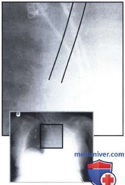 Рентгеновский снимок с затемнением в левом легком после интубации