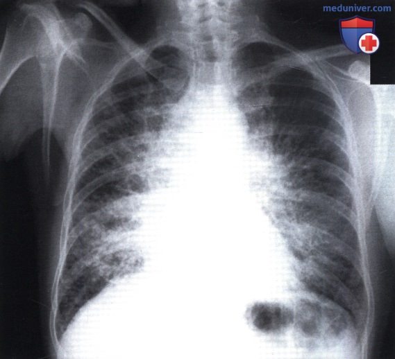 Рентгеновский снимок с затемнением обоих легочных полей при лимфангите