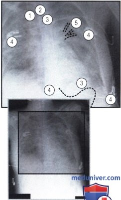 Рентгеновский снимок с затемнением в обоих легких при ОРДС
