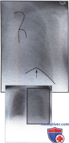 Рентгеновский снимок с затемнением левого легкого
