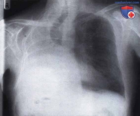 Рентгеновский снимок с затемнением правого легочного поля после пульмонэктомии