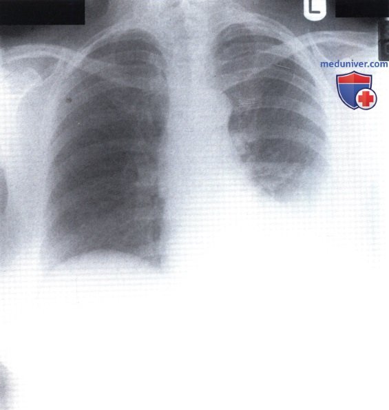 Рентгеновский снимок с областью затемнения в левом легком при выпоте (плеврите)