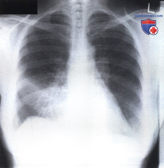 Рентгеновский снимок с затемнением в нижнем отделе правого легочного поля при пневмонии