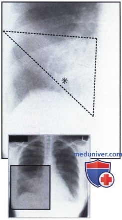 Рентгеновский снимок с затемнением в нижнем отделе правого легочного поля при пневмонии
