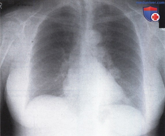 Рентгеновский снимок с участком затемнения в левом легком