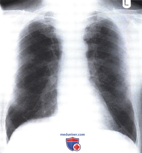 Рентгенограмма с патологией средостения при увеличении щитовидной железы