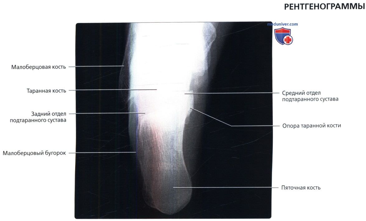 Рентгенограмма голеностопного сустава (голеностопа) в норме