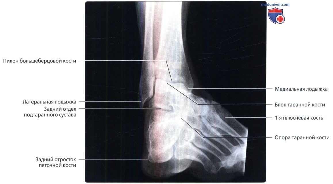 Укладка голеностопного сустава. Пяточная кость рентген анатомия. Рентгенография голеностопного сустава в боковой проекции. Рентген голеностопного сустава в боковой проекции. Рентгенограмма голеностопного сустава в норме.