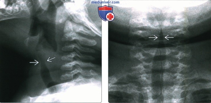 Рентгенограмма при крупе (остром ларинготрахеите)
