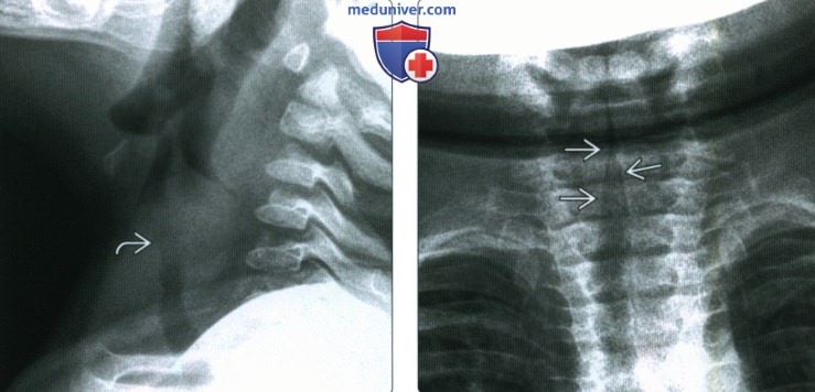 Рентгенограмма при крупе (остром ларинготрахеите)