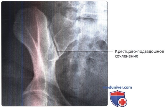 Рентгенограмма таза и тазобедренного сустава в норме