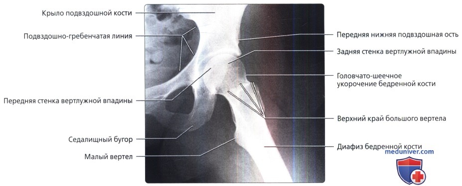 Рентгенограмма таза и тазобедренного сустава в норме