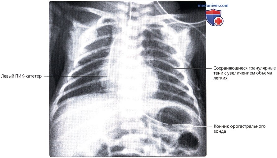 Рентгенограмма при респираторном дистресс синдроме у новорожденного
