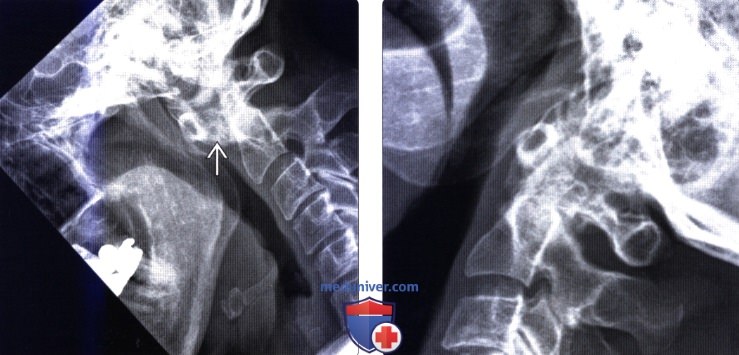 Рентгенограмма позвоночника при ревматоидном артрите взрослых