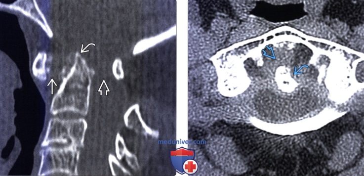 Ревматоидный артрит и томография thumbnail