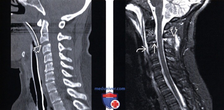 ,   SCIWORA (spinal cord injury without radiographic abnormality)