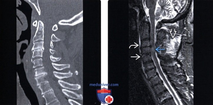 ,   SCIWORA (spinal cord injury without radiographic abnormality)