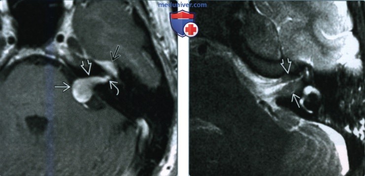 Шваннома лицевого нерва мостомозжечкового угла (ММУ) и внутреннего слухового канала (ВСК) - лучевая диагностика