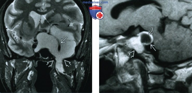 Шваннома тройничного нерва центральной части основания черепа - лучевая диагностика