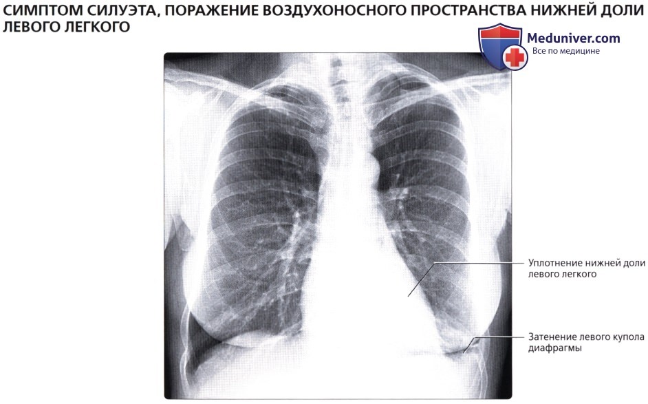Симптом силуэта на рентгенограмме органов грудной клетки