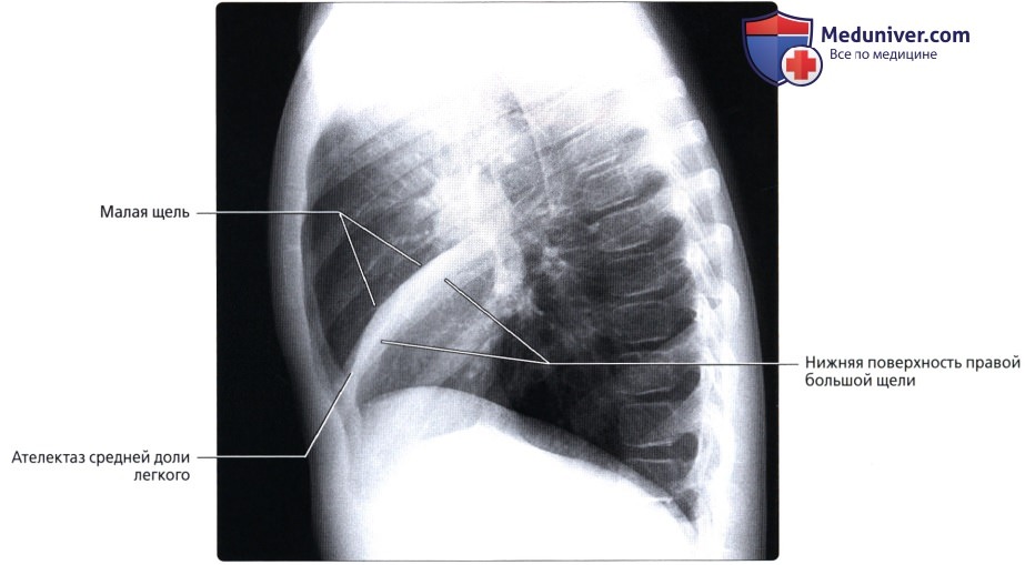Симптом силуэта на рентгенограмме органов грудной клетки