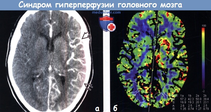 Синдром гиперперфузии головного мозга на КТ, МРТ