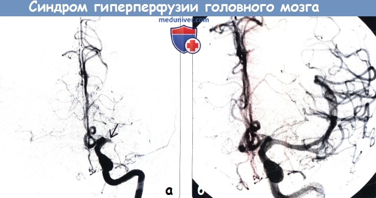 Синдром гиперперфузии головного мозга на МРТ