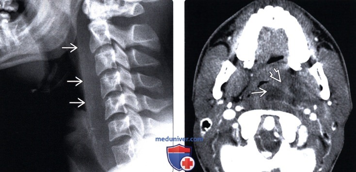 Рентгенограмма, КТ, МРТ при синдроме Гризеля