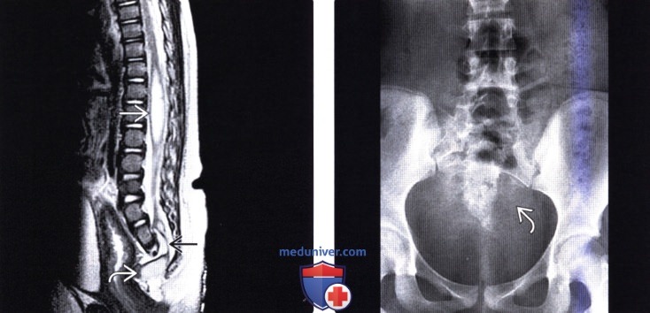 МРТ, рентгенограмма при синдроме каудальной регрессии