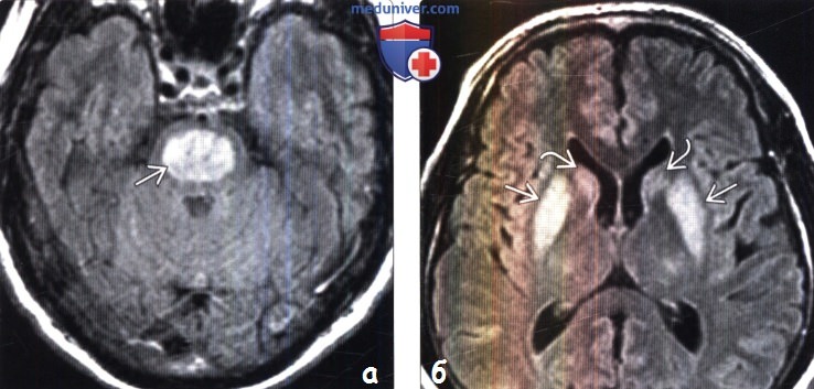 Синдром осмотической демиелинизации по МРТ головного мозга