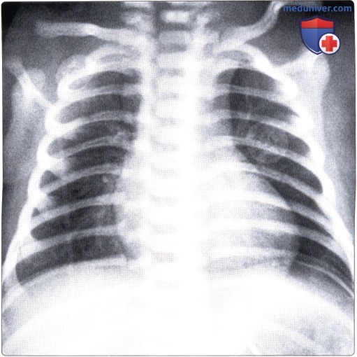 Рентгенограмма при синдроме сохранения жидкости в легочной ткани у новорожденного