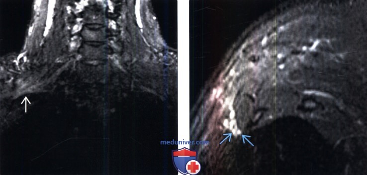 Рентгенограмма, МРТ при синдроме верхней апертуры грудной клетки