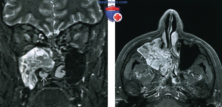 Синоназальная инвертированная папиллома - лучевая диагностика