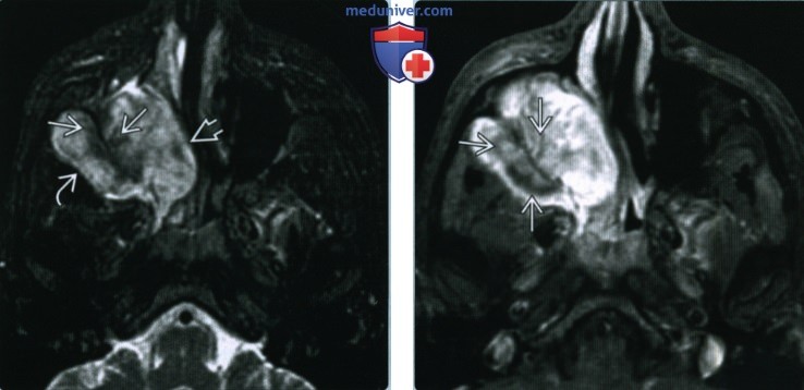 Синоназальная остеосаркома - лучевая диагностика