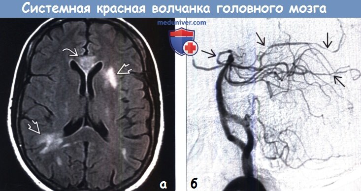 Системная красная волчанка головного мозга на МРТ, ангиограмме