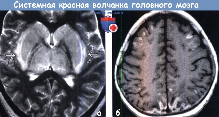 Системная красная волчанка головного мозга на МРТ