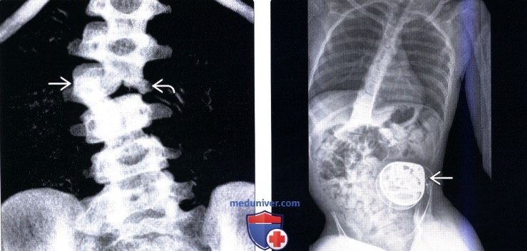 КТ, рентгенограмма позвоночника при сколиозе
