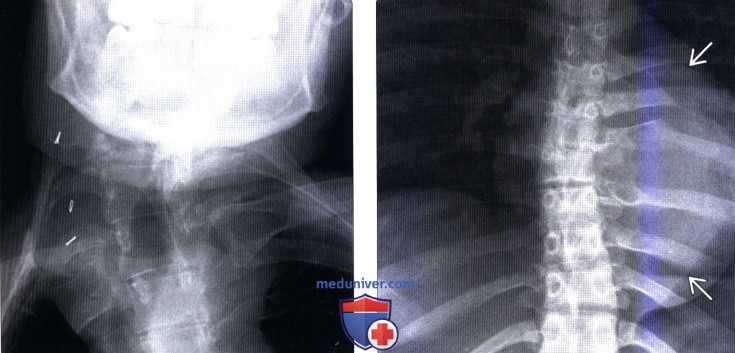 Рентгенограмма позвоночника при сколиозе